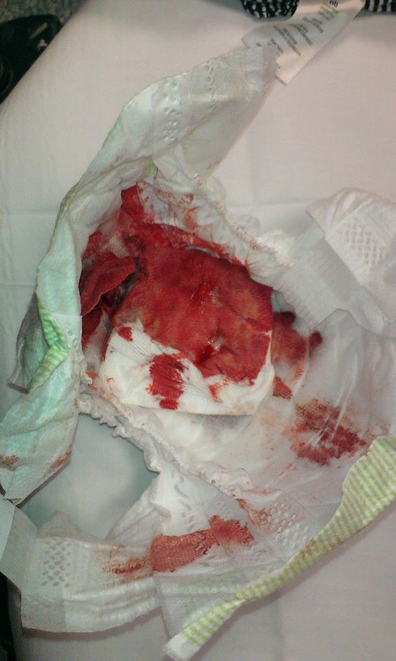 bloody diaper of boy in Tennessee
