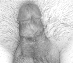 Circumcised penis
