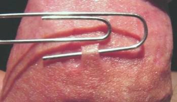 Shaft skin bridge exposed by paperclip