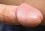 Circumcised penis with matt pinkish glans